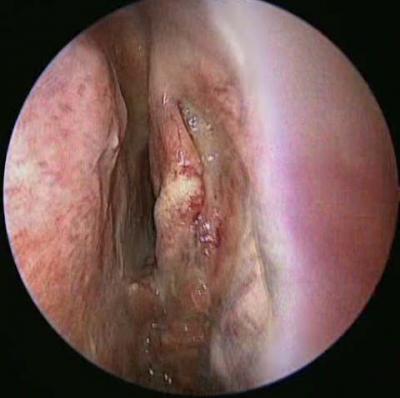 Figure 1: Endoscopic picture of the left nasal cavity which shows a polypoidal fleshy mass (double arrows) arising from the middle meatus and extending into the nasopharyx (single arrow pointing to the middle tur- binate).